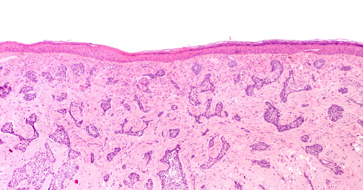 carcinom cutanat la microscop pentru tratament cu Metoda Mohs