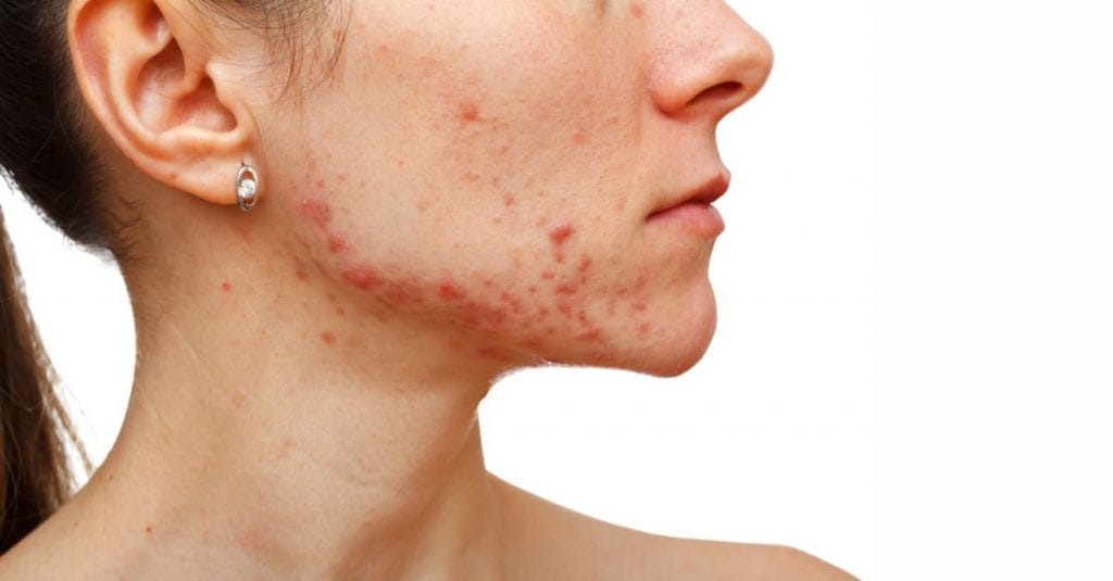 Acneea vulgară, afecțiunea care nu are milă de frumusețea feței - Dr ...