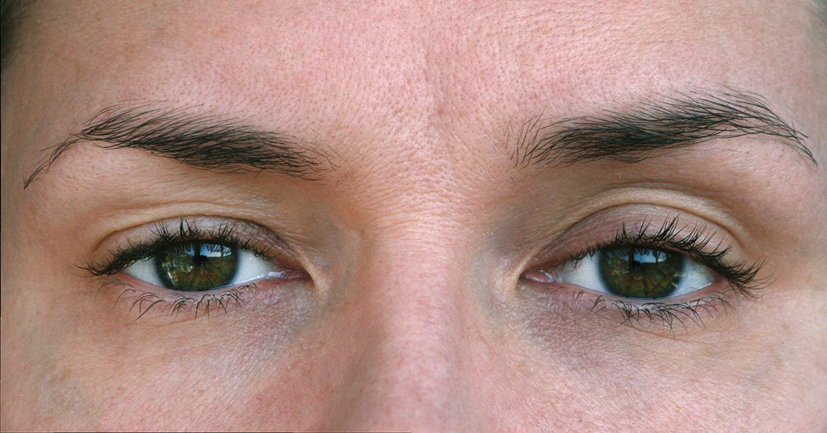 ptoza și tulburări de vedere acuitate vizuală la copiii cu cataractă