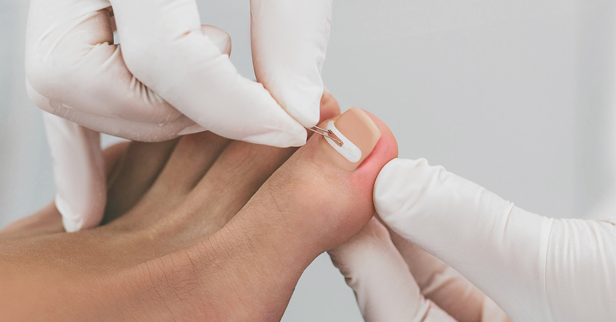 unghie incarnata la picior, doctor care examineaza |Dr. Leventer Centre