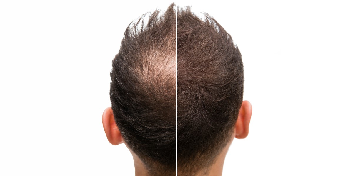 alopecie, cap de barbat cu sau fara alopecie | Dr. Leventer Centre