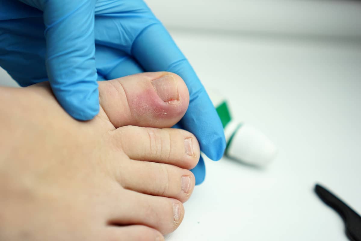 barbat cu unghie incarnata cu puroi