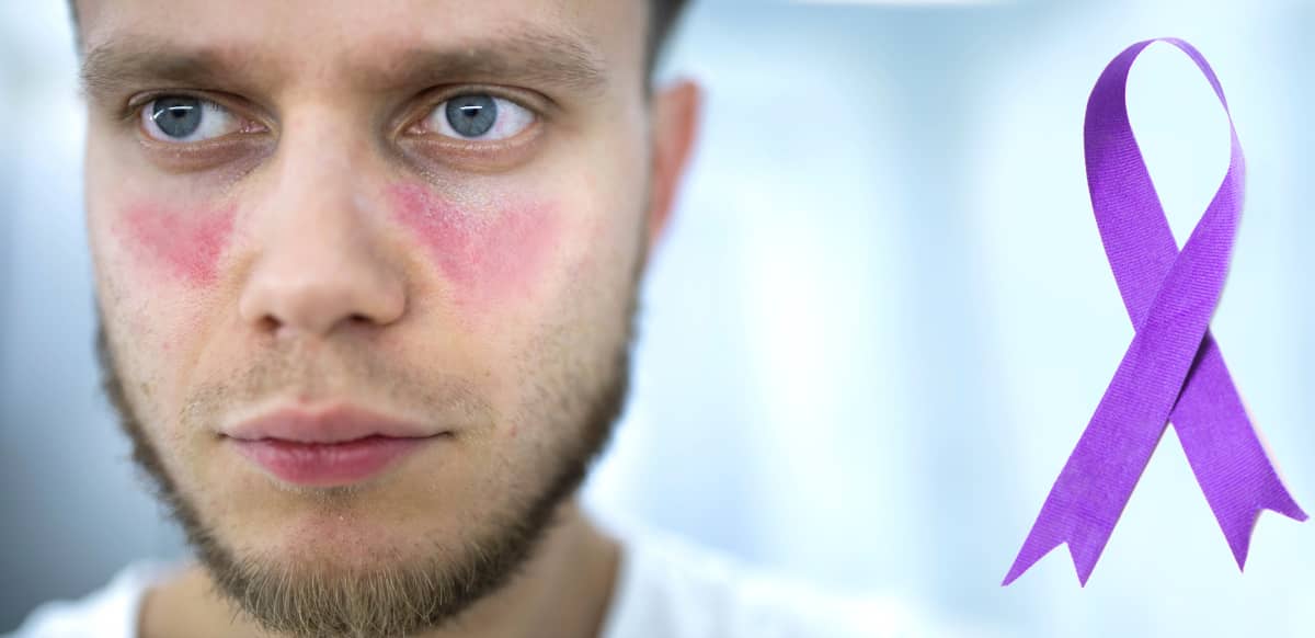 barbat cu eruptie cutanata specifica in lupus