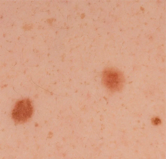 Aluniță obișnuită