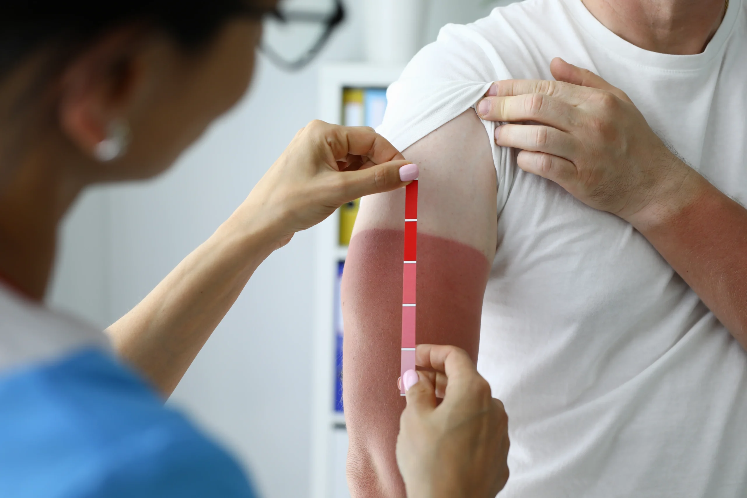 medic dermatolog evaluează arsura solară pe braț