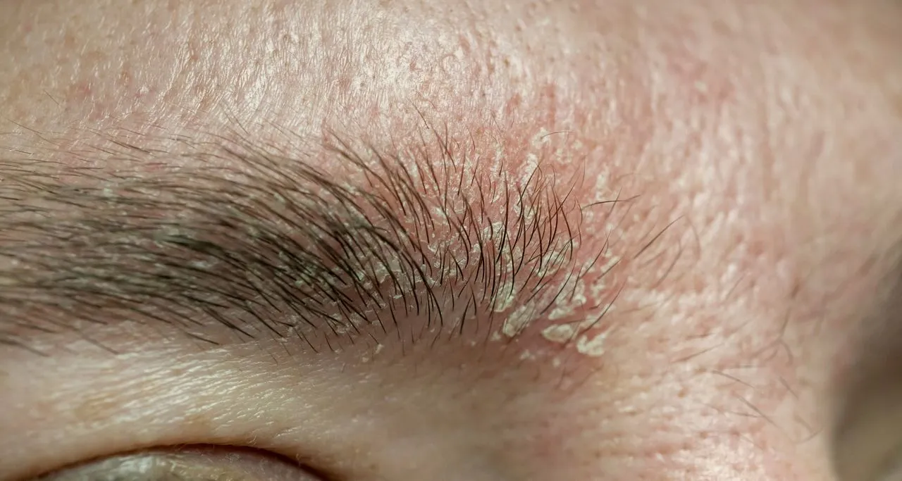 dermatita seboreica