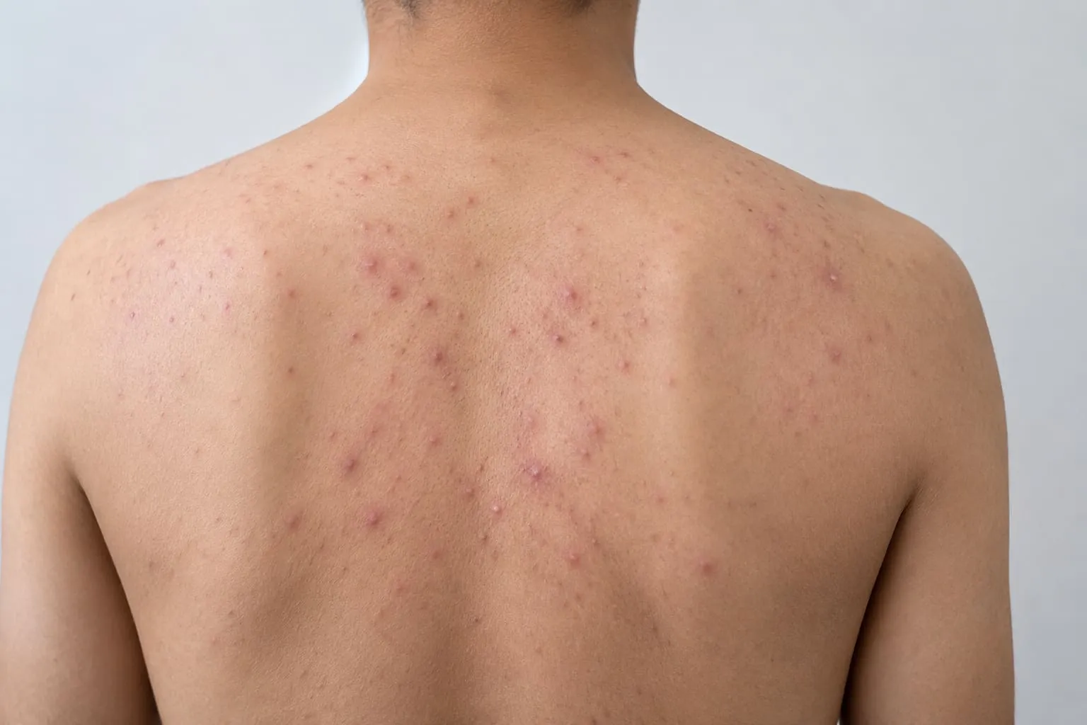 Leziuni inflamatorii de acnee pe partea superioară a spatelui