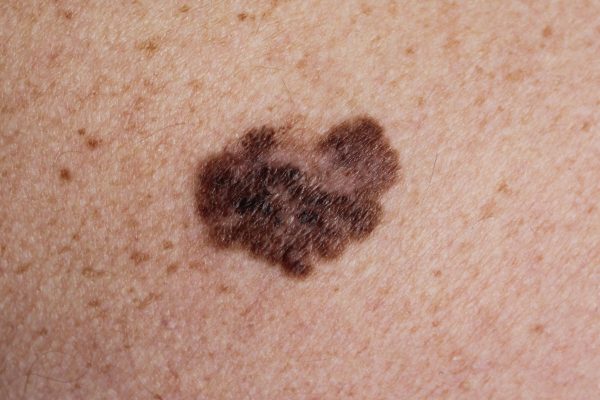 Melanoma,-,A,Malignant,Tumor,Of,The,Skin