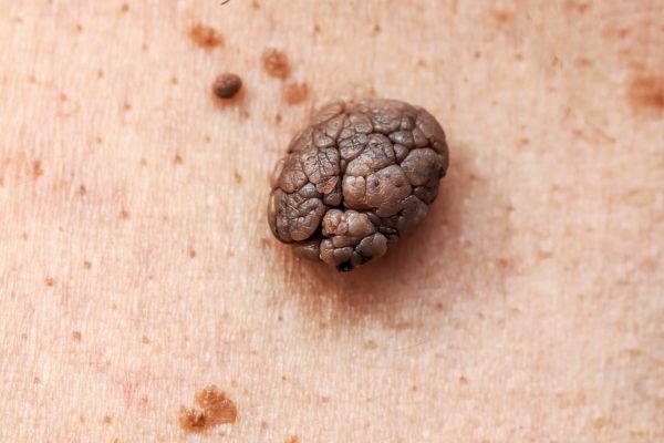 Red,Mole,,Growth,,Wart,,Nevus,On,Human,Skin,Close-up