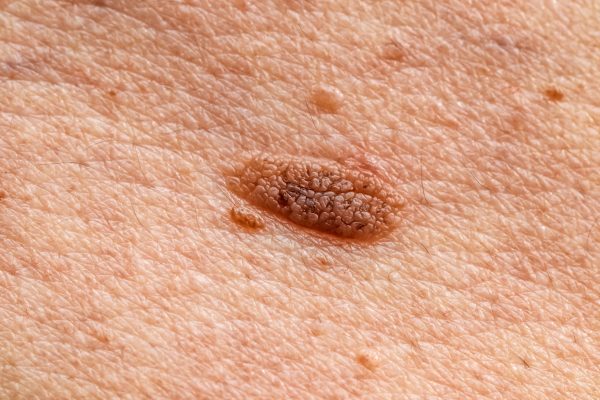 Red,Mole,,Growth,,Wart,,Nevus,On,Human,Skin,Close-up