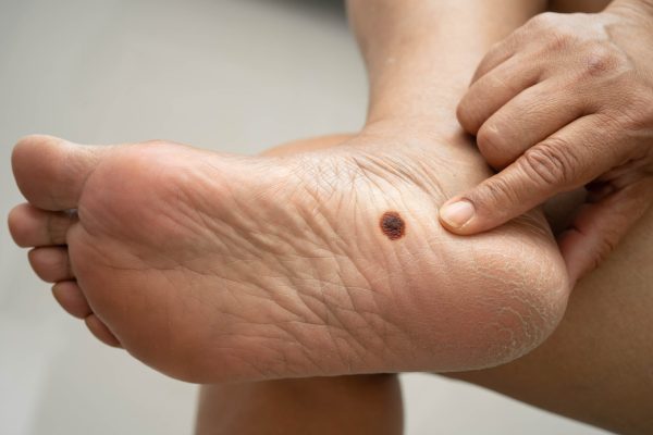 Asian woman check feet with crack and dry heel skin, Diabetic Foot.