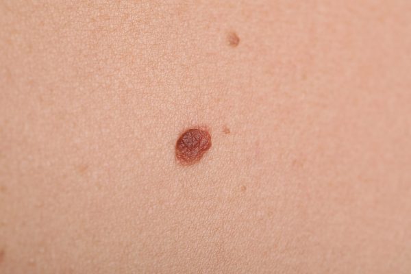 Woman,With,Moles,On,Her,Body,,Closeup
