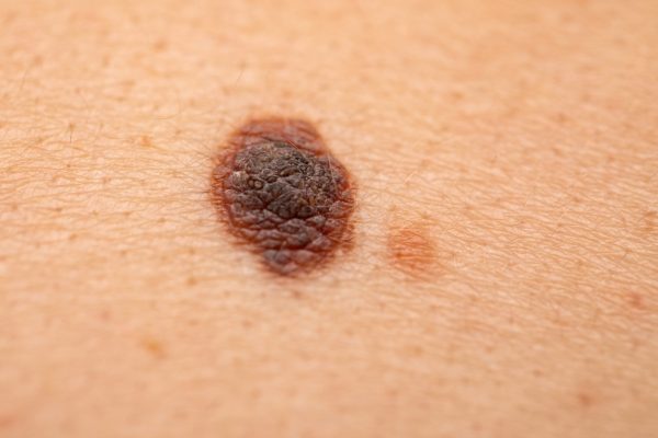 Close,Up,Picture,Of,Dangerous,Brown,Nevus,On,Human,Skin